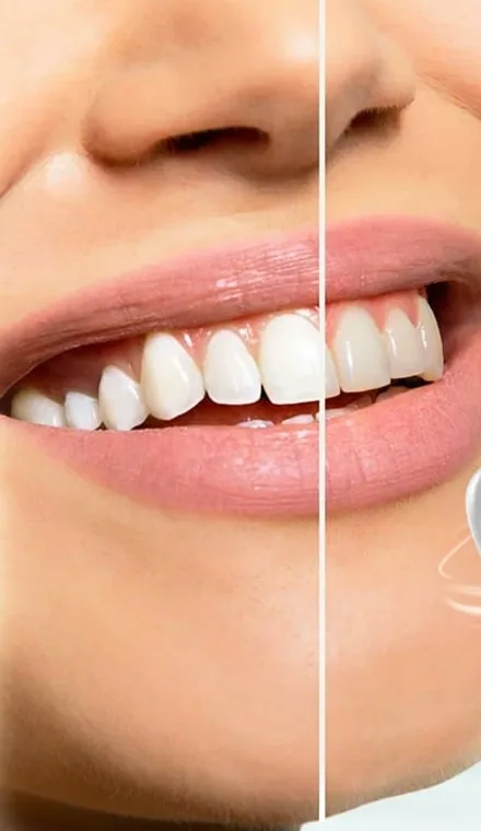 Offer Whitening Smile
