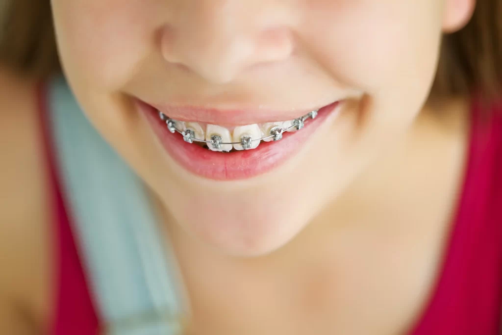 Patient with braces at Mint Dental Care