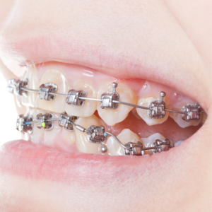 braces