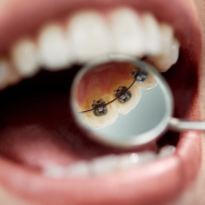 Lingual Braces