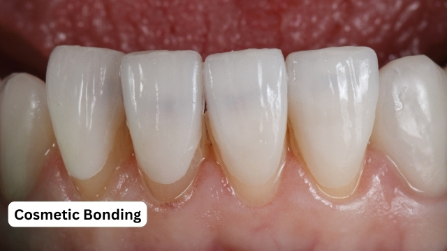 Composite Bonding