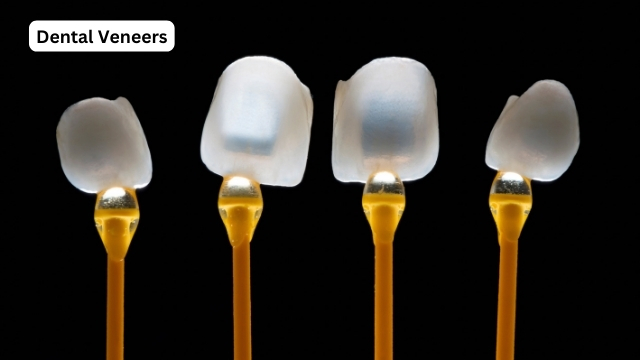 Veneers
