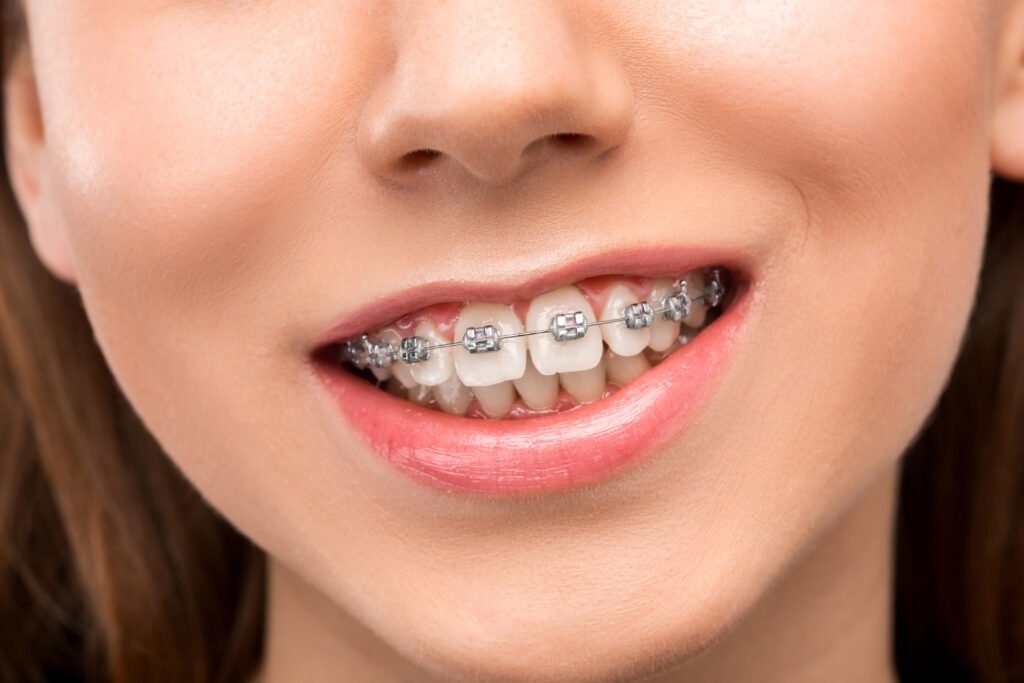 Orthodontic patient at Mint Dental Care