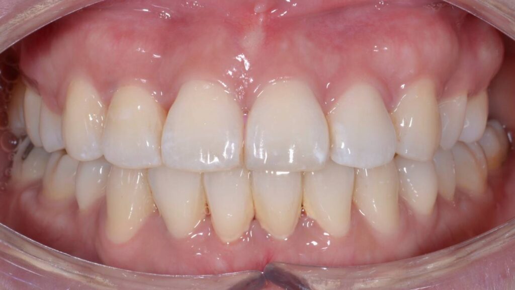 Warapan after treatment