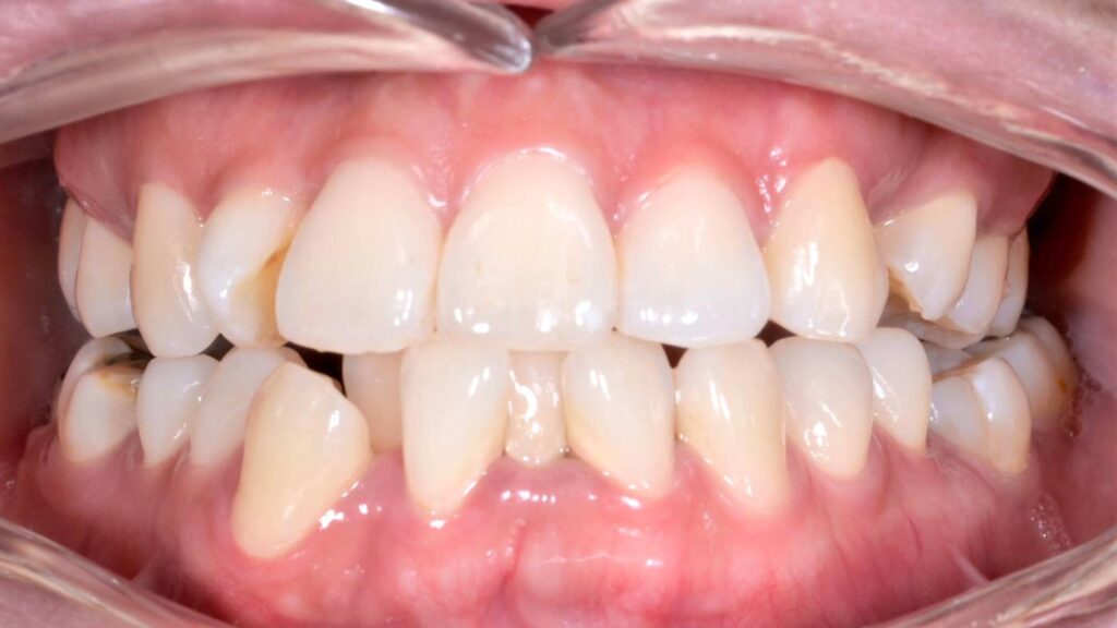 Warapan before treatment