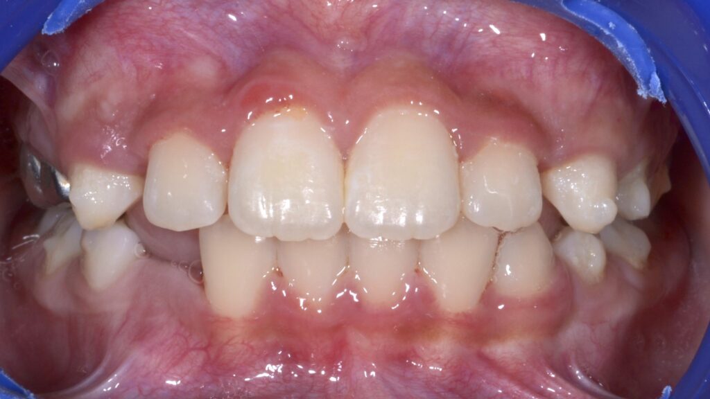 Maitha after treatment