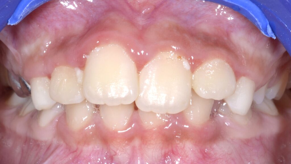 Maitha before treatment
