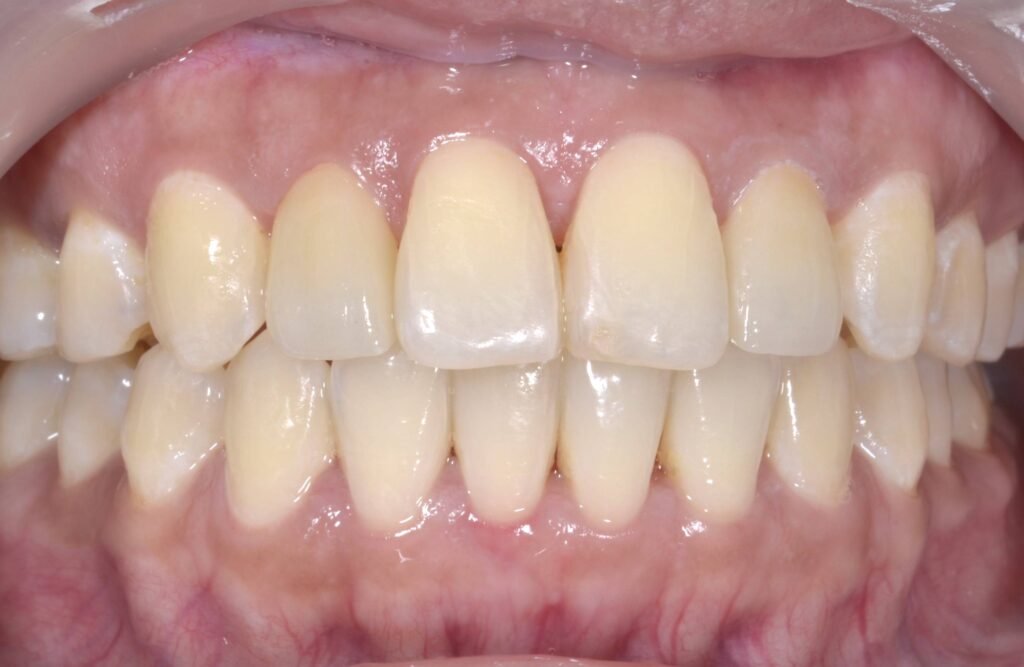 Shela after treatment