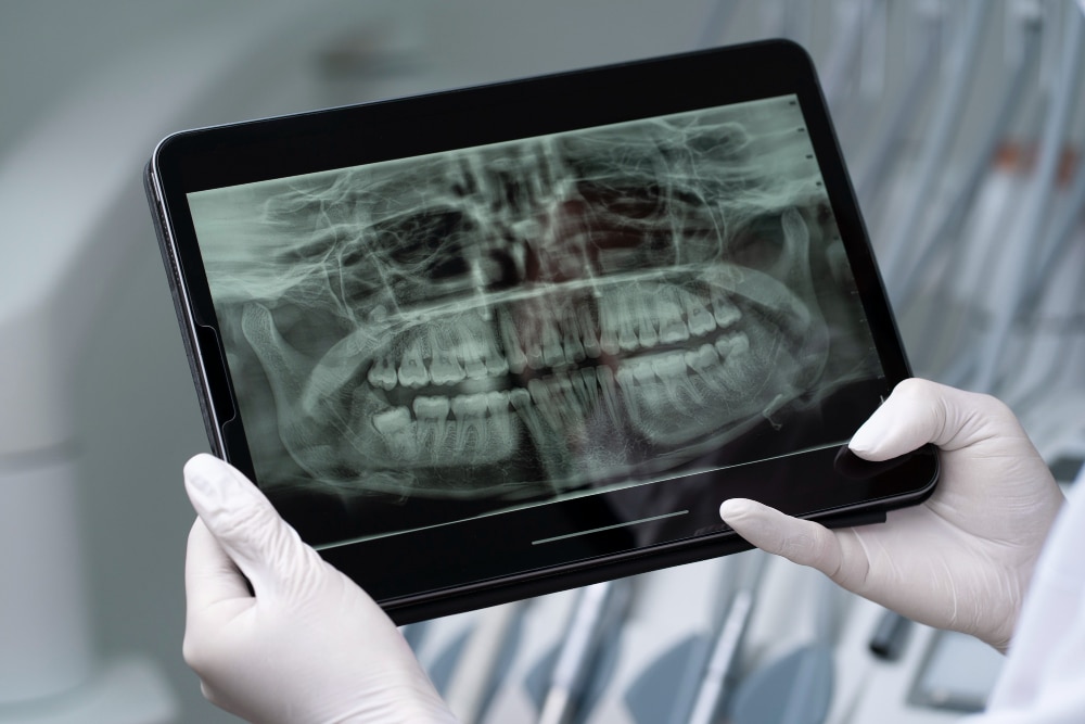 Dental X-ray used for jaw surgery planning