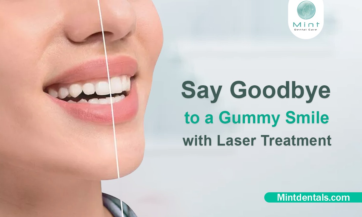 Gummy Smile Treatment