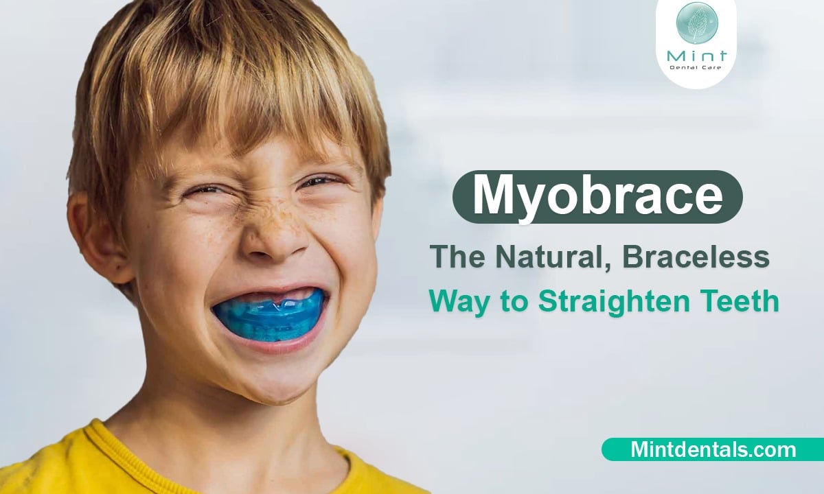 The Concept Behind Myobrace The Myobrace system stands apart from traditional orthodontic treatments. Rather than relying solely on