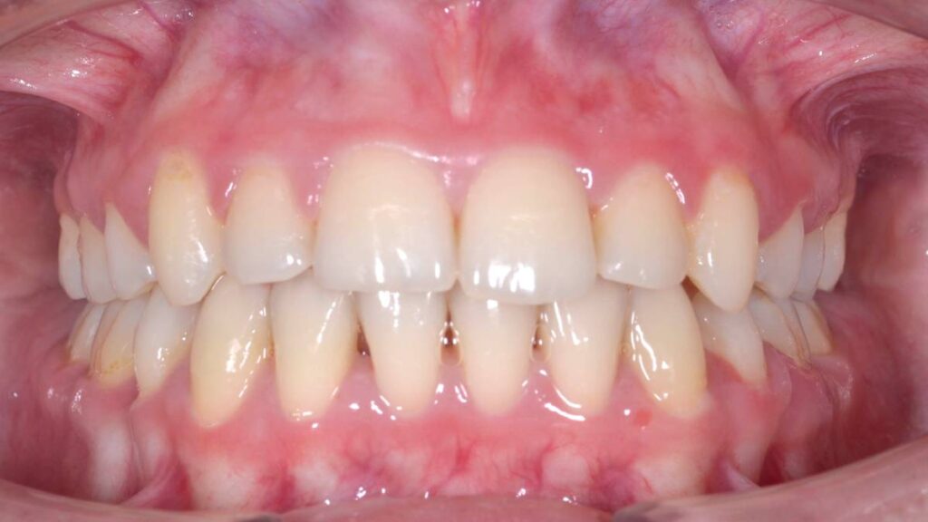 After treatment at Mint Dental Care