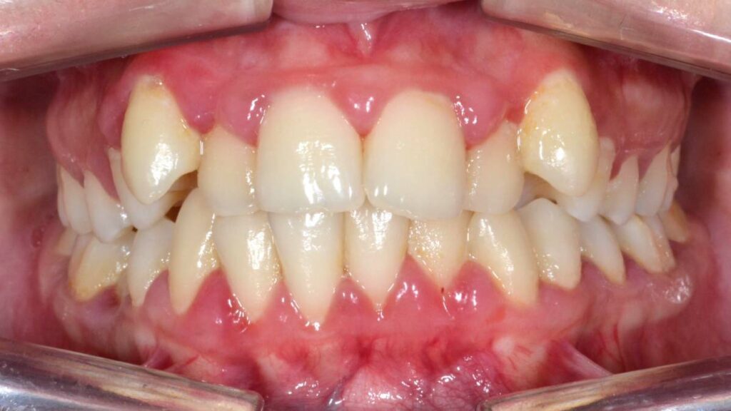 Before treatment at Mint Dental Care