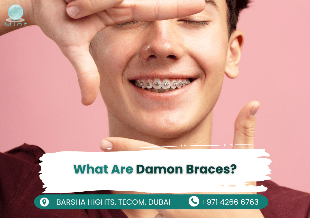 Close-up of Damon Braces, a self-ligating orthodontic system with a slide mechanism instead of elastic bands, offering faster and more