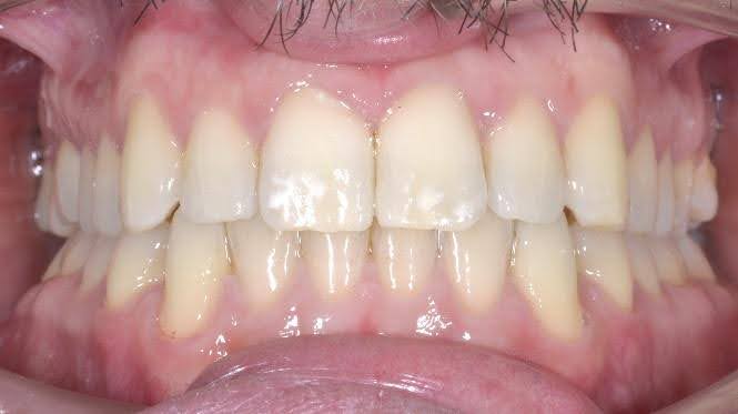 Marco after treatment