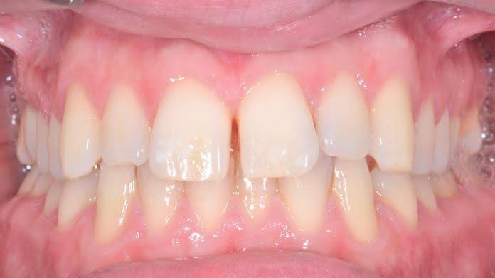 Marco before treatment