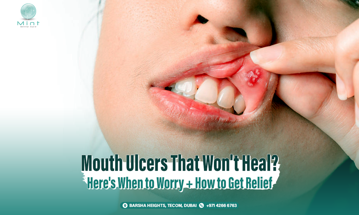 Mouth Ulcers That Won&#8217;t Heal? Here&#8217;s When to Worry + How to Get Relief