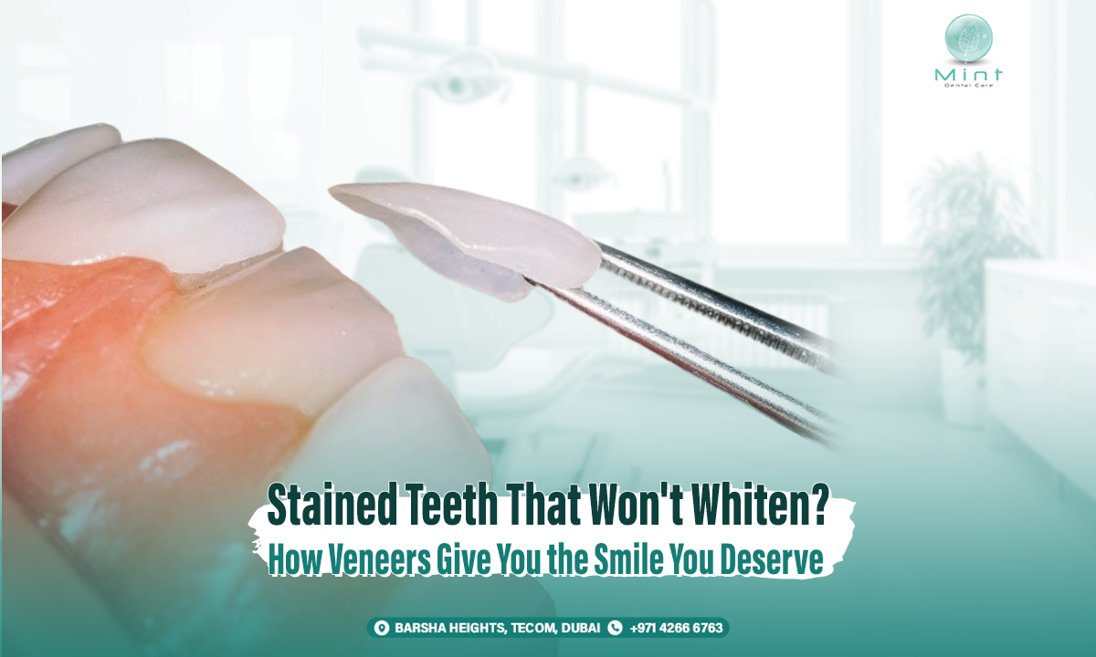 Stained Teeth That Won&#8217;t Whiten? How Veneers Give You the Smile You Deserve