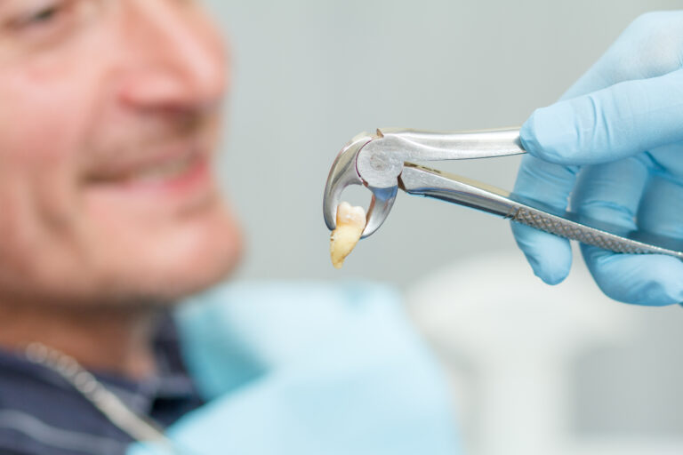 Surgical Extractions