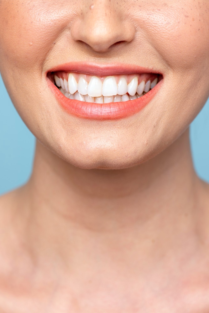 What Is a Hollywood Smile Makeover?