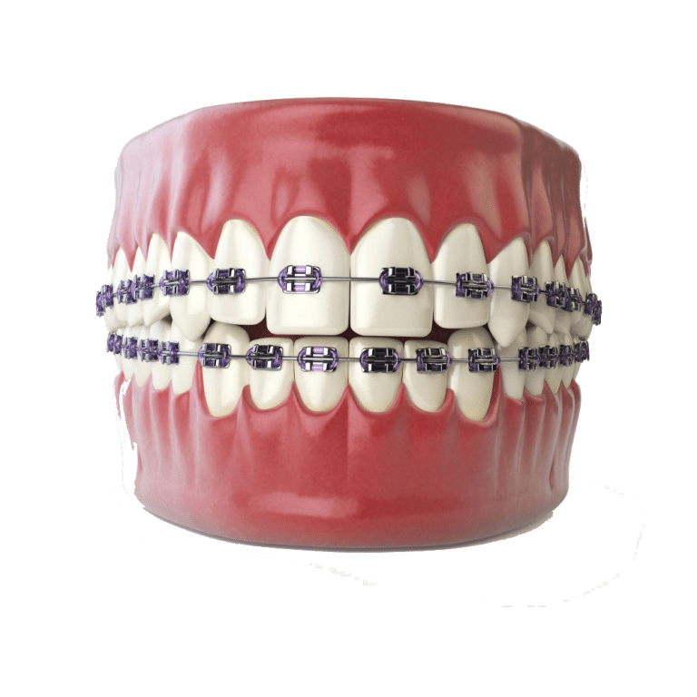 Braces