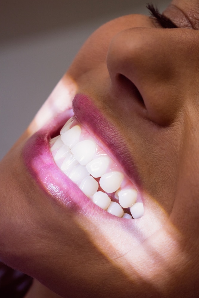مريضة بعد تبييض الأسنان في Mint Dental Care