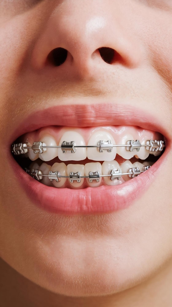 Types of braces