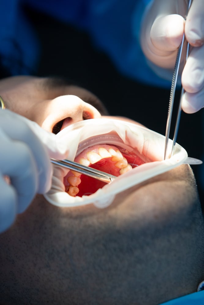 The Root Canal Treatments Procedure