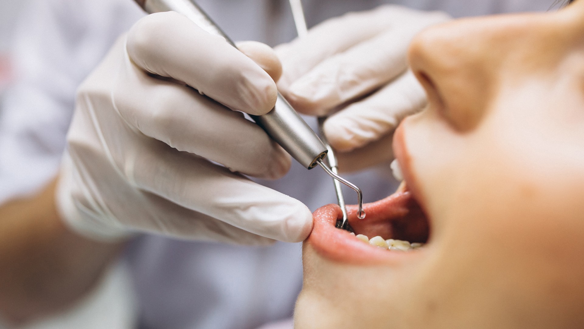 Wisdom Tooth Extraction at Mint Dental Care Dubai