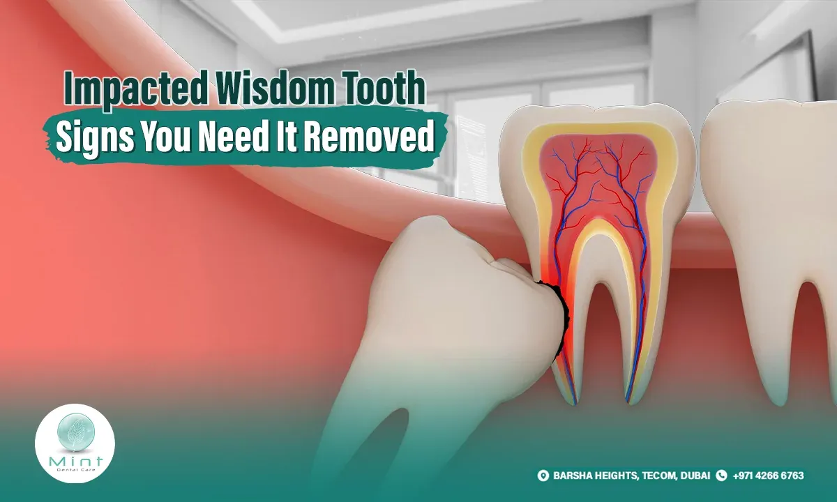 Impacted Wisdom Tooth: Signs You Need It Removed
