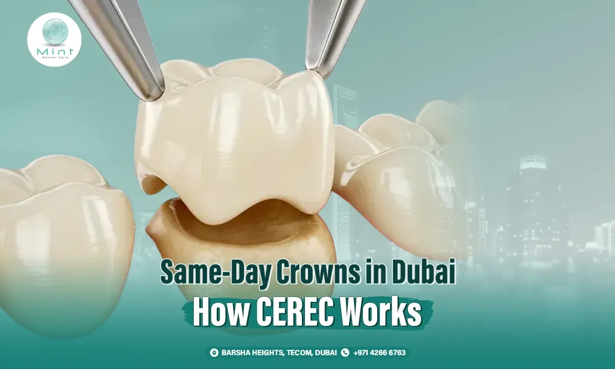Same-Day Crowns in Dubai: How CEREC Works