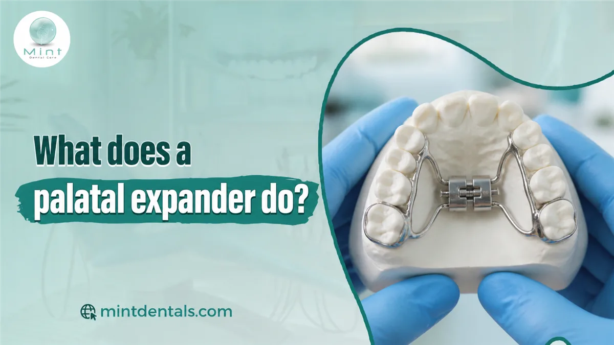 What does a palatal expander do?