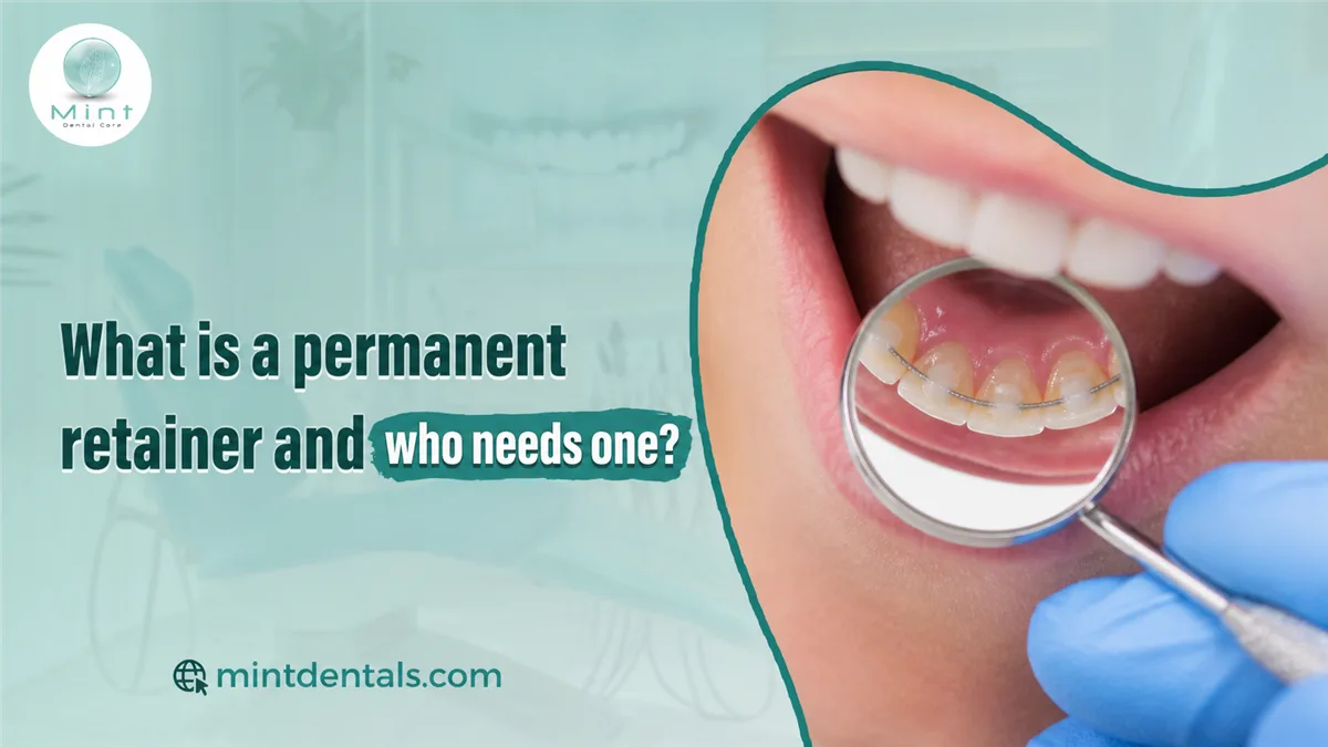 What is a permanent retainer and who needs one?