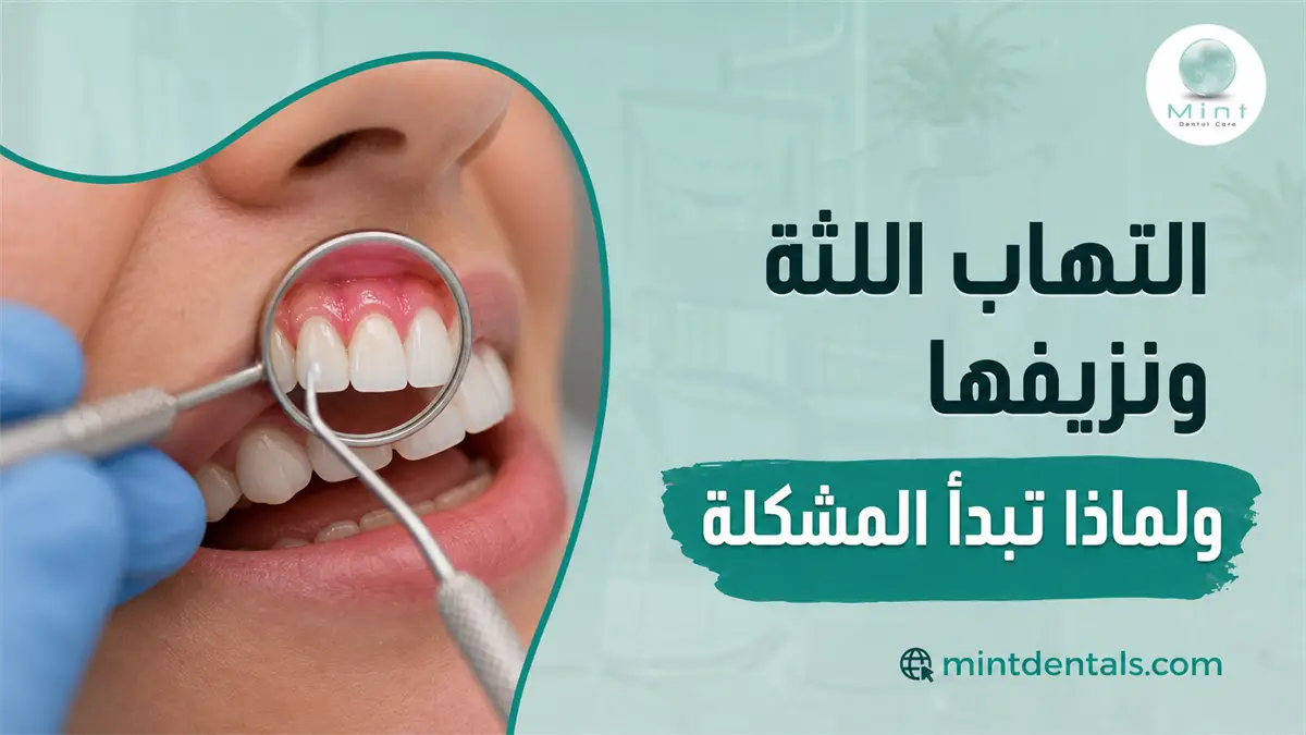 التهاب اللثة ونزيفها مع فحص اللثة باستخدام مرآة الأسنان وتوضيح الاحمرار وأسباب بداية المشكلة.