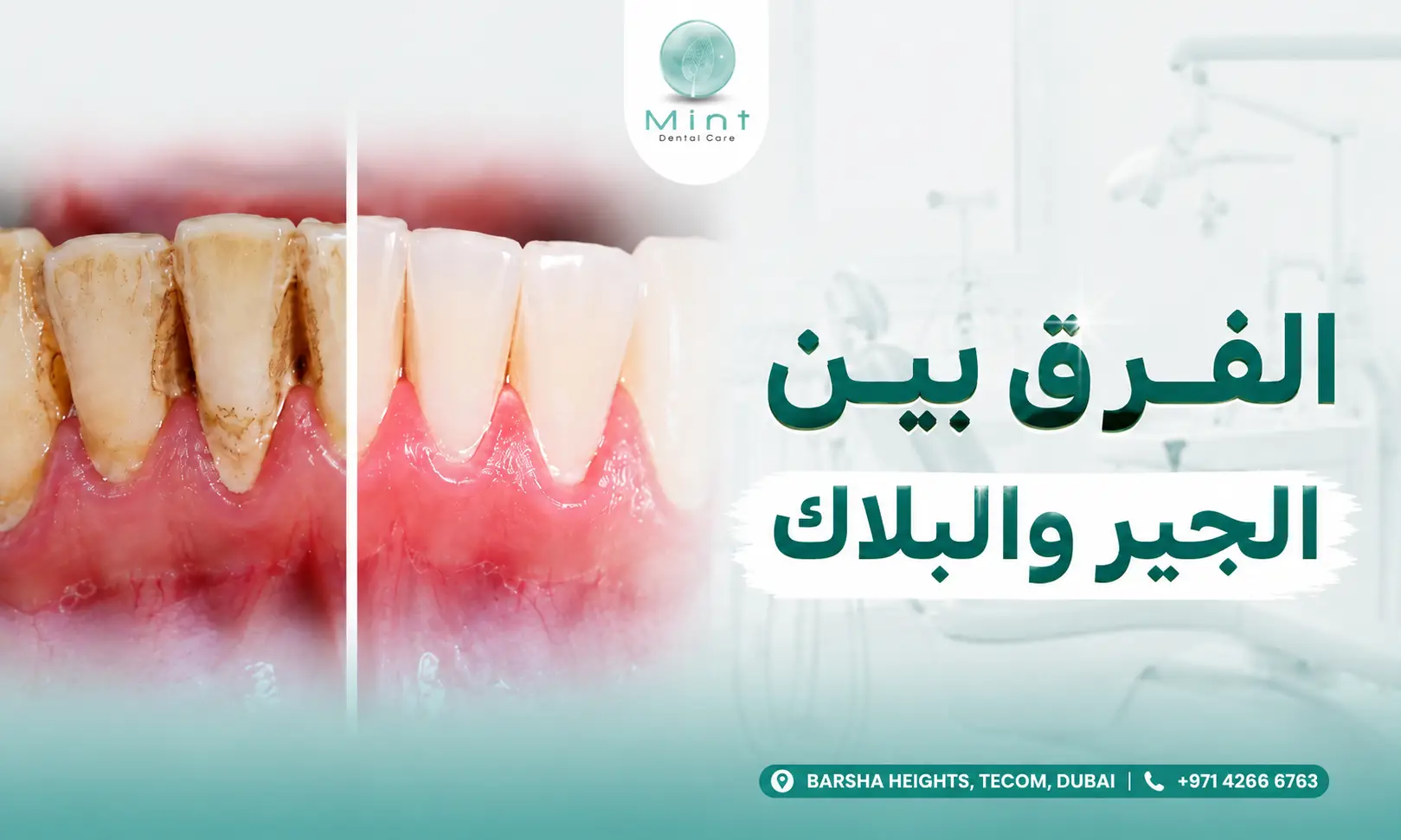 الفرق بين جير الأسنان والبلاك مع مقارنة بين الأسنان التي تحتوي على تراكمات جيرية والأسنان النظيفة