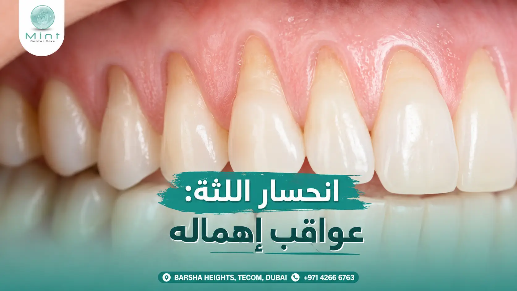 انحسار اللثة مع ظهور تراجع اللثة وانكشاف جزء من جذور الأسنان وتوضيح عواقب الإهمال وطرق العلاج.