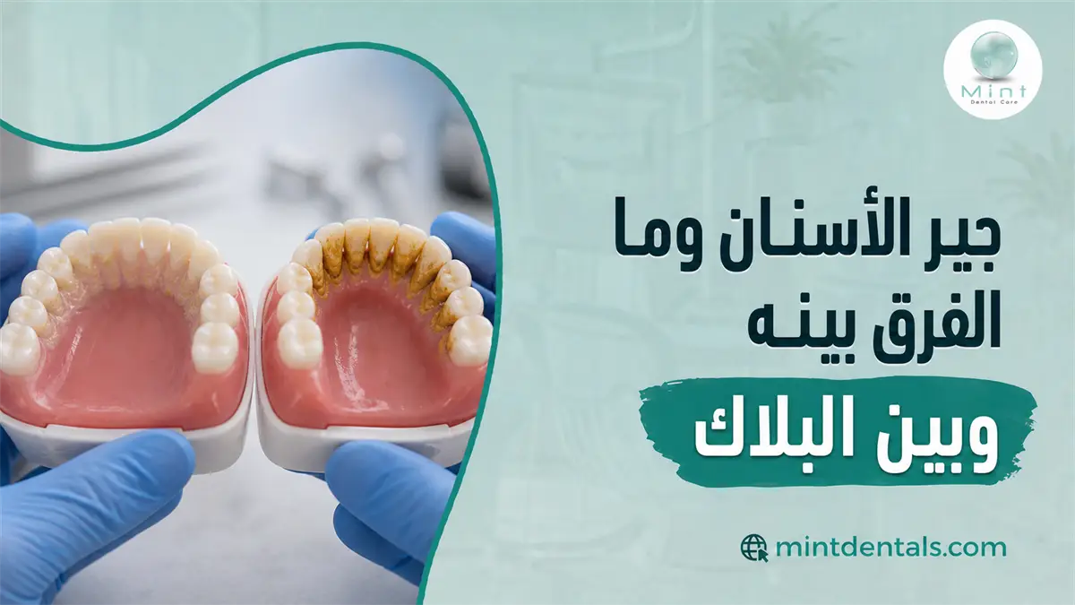 جير الأسنان والفرق بينه وبين البلاك مع نموذجين يوضحان الأسنان النظيفة والأسنان التي تحتوي على