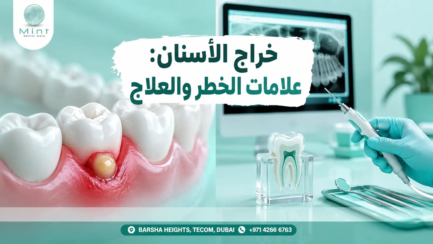 خراج الأسنان مع ظهور تورم والتهاب في اللثة بجوار السن وتوضيح علامات الخطر وطرق العلاج.