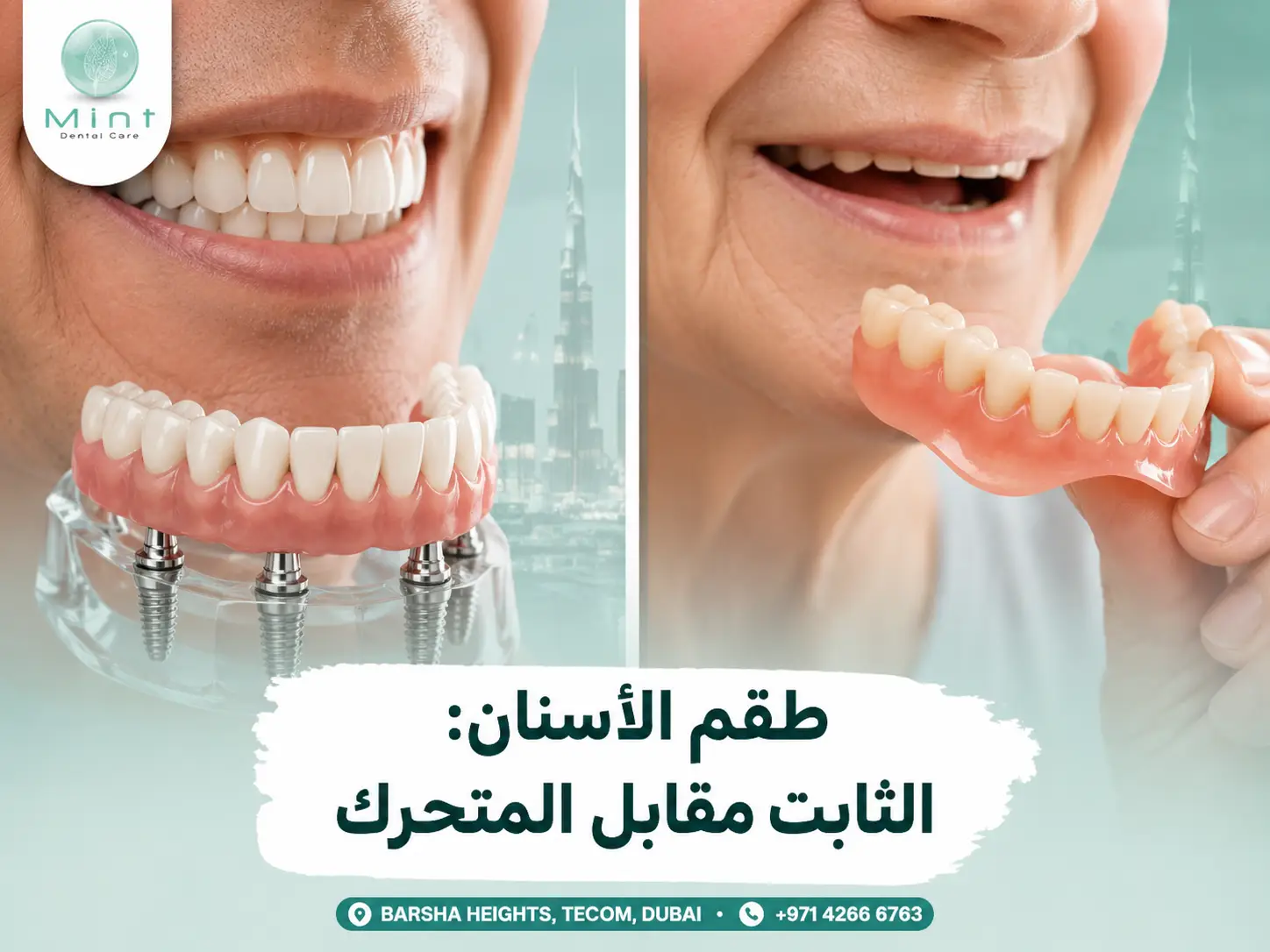 طقم الأسنان الثابت مقابل المتحرك مع مقارنة بين التركيبات المثبتة على الزرعات وطقم الأسنان القابل