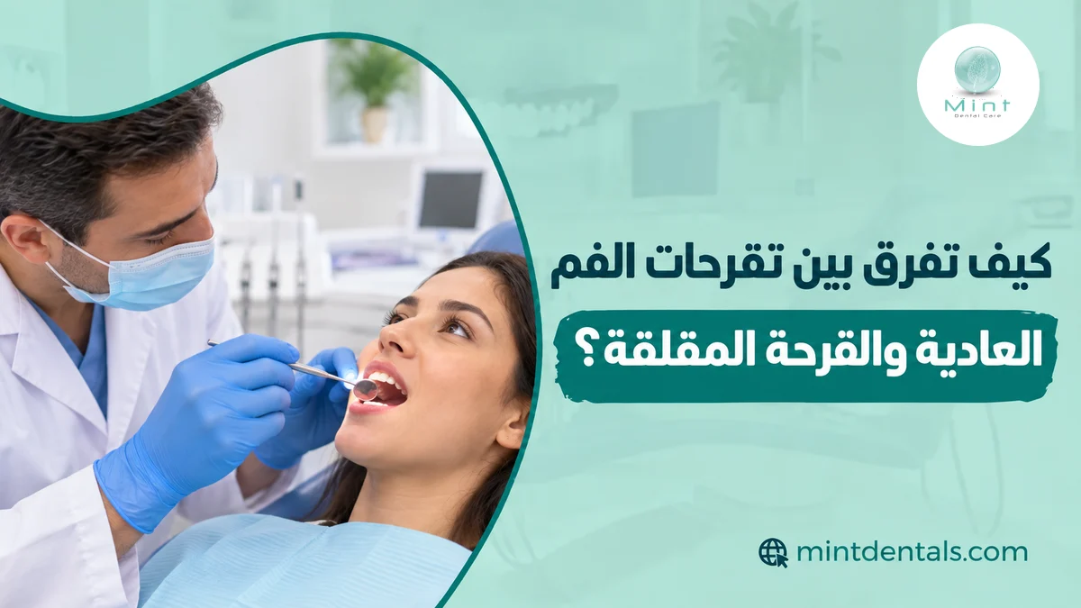 كيف تفرق بين تقرحات الفم العادية والقرحة المقلقة؟