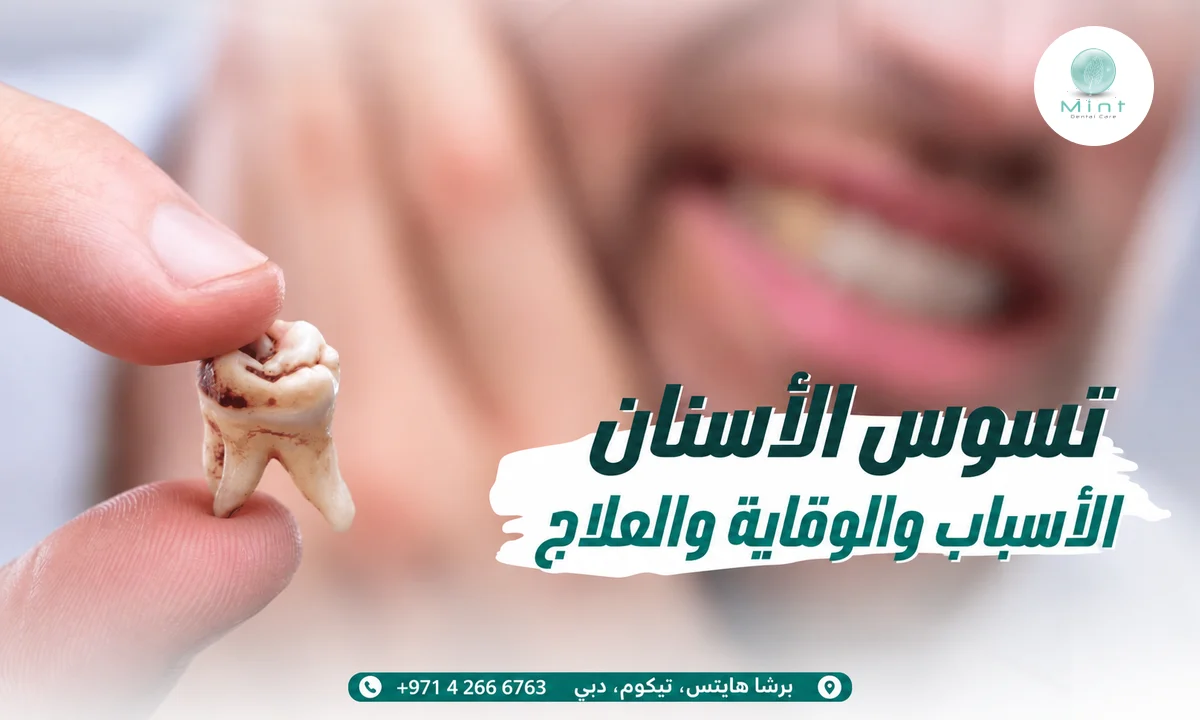 تسوس الأسنان: الأسباب والوقاية والعلاج