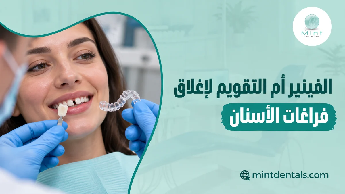 الفينير أم التقويم لإغلاق فراغات الأسنان