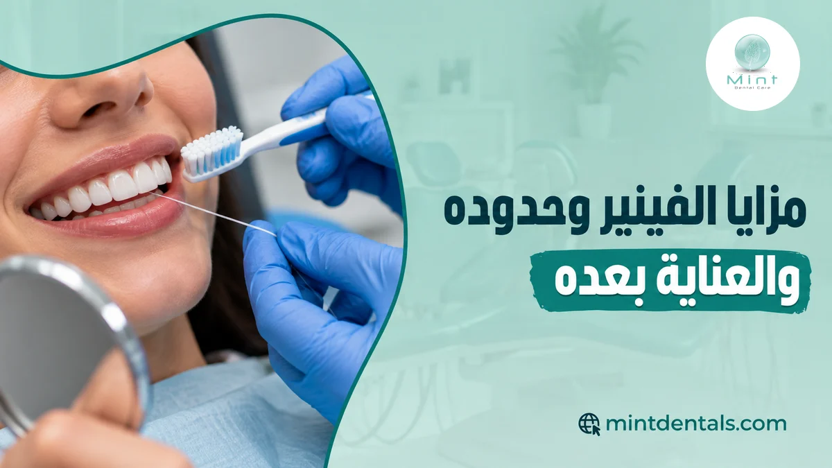 مزايا الفينير وحدوده والعناية بعده