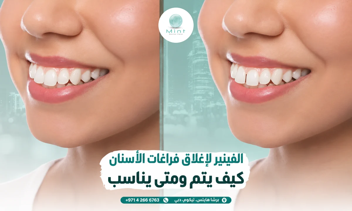 الفينير لإغلاق فراغات الأسنان: كيف يتم ومتى يناسب
