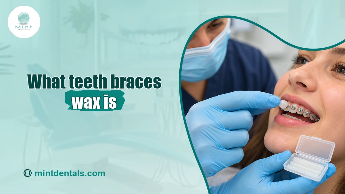 Orthodontic wax applied to a sore braces bracket