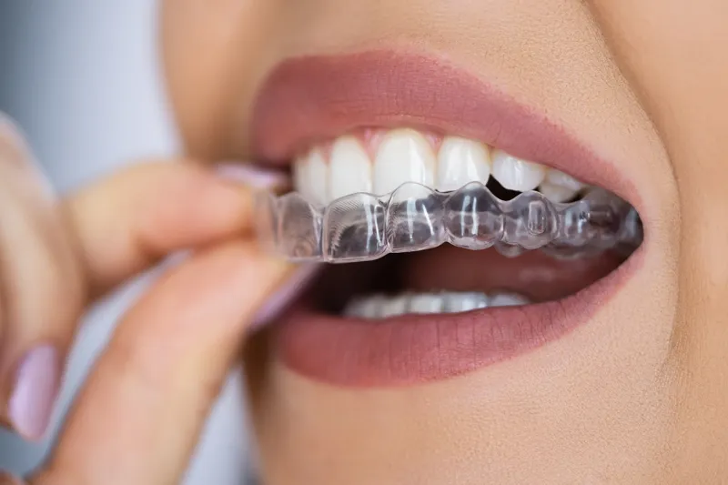 Invisalign for Teens vs. Adults